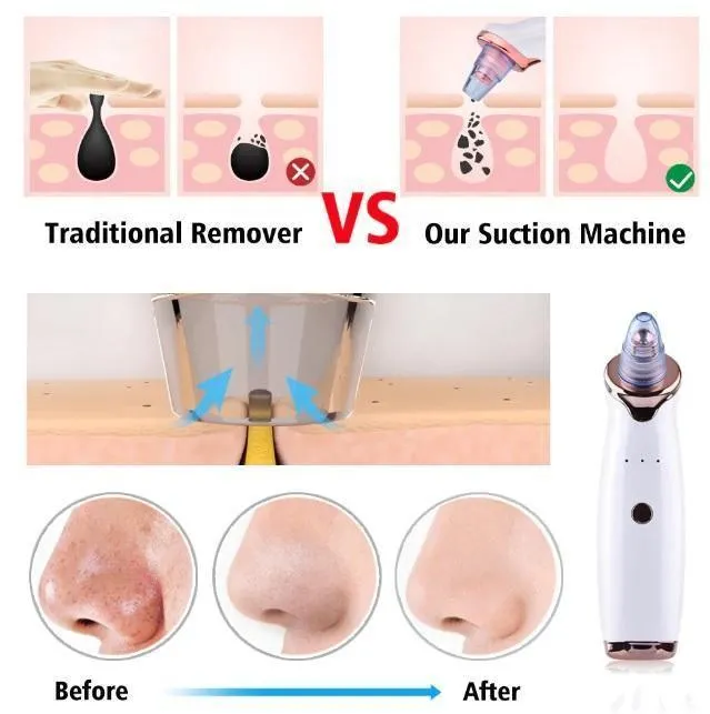 Blackhead Remover Vacuum With Needle Set